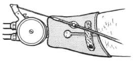 Fig. 5. Wrist-disarticulation Socket For Use | O&P Digital Resource Library