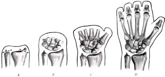 Fig. 1. Levels Of Hand Amputation Requiring Pr | O&P Digital Resource ...