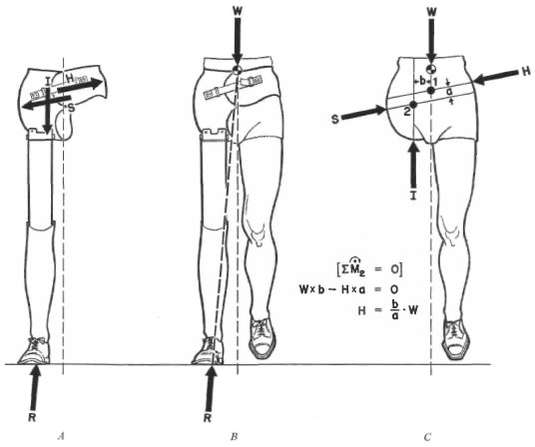 Fig. 9. Mediolateral Force Diagram Of The Cana | O&P Digital Resource ...