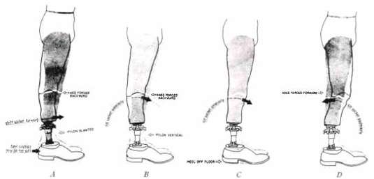 Fig. 35. Faults In Anteroposterior Alignment | O&P Digital Resource Library