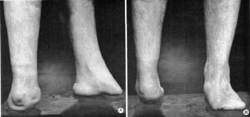 Fig. 1. Congenital Bilateral Amputations With | O&P Digital Resource ...