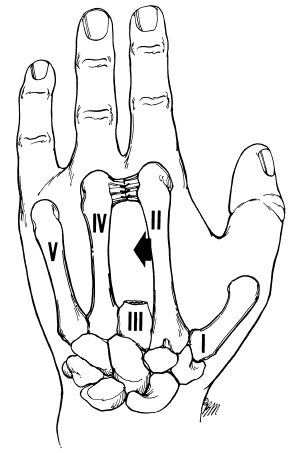 Fig 7A-13. An Alternative Technique For Long-f | O&P Digital Resource ...