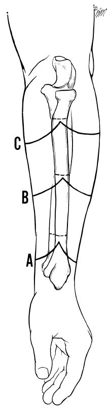 Fig 8A-3. Three Levels Of Forearm Amputation. | O&P Digital Resource ...