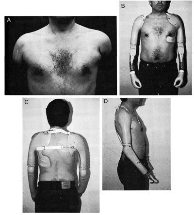 Fig 12B-2. A, High-level Bilateral Upper-limb | O&P Digital Resource ...