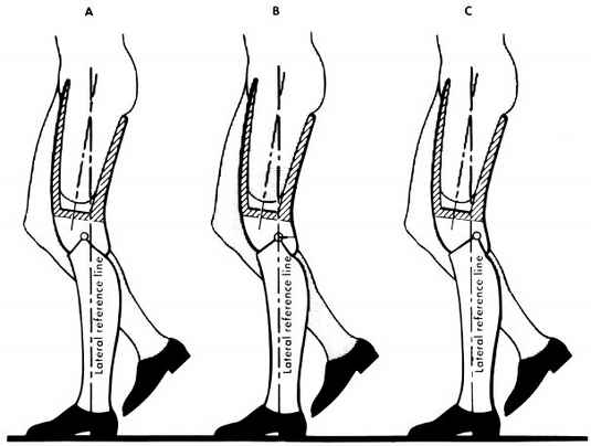 Fig 20B-1. Transfemoral Alignment Variations A | O&P Digital Resource ...