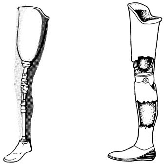 exoskeletal prosthesis