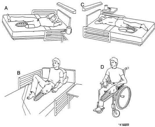 Fig 23-5. Proper Residual-limb Positioning. A, | O&P Digital Resource ...