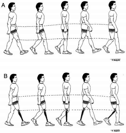 Fig 23-11. A, Nonamputee Vertical Displacement | O&P Digital Resource ...