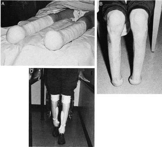 Fig 24A-5. A, A 56-year-old Male With Bilatera | O&P Digital Resource ...