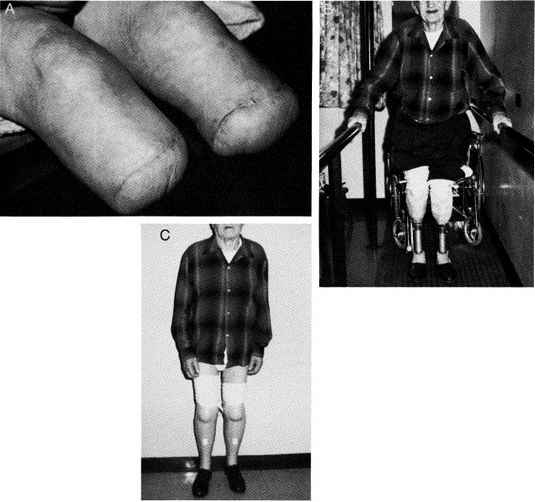 Fig 24A-6. A, 92-year-old Male With Peripheral | O&P Digital Resource ...