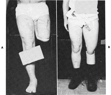 Fig 35A-9. A, Transfemoral Amputation With The | O&P Digital Resource ...