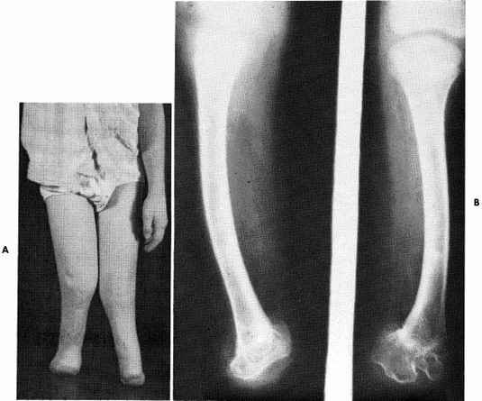 Fig 35A-19. A, Boyd Amputation Stumps. B, Radi | O&P Digital Resource ...