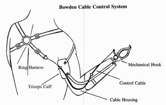 below elbow prosthesis