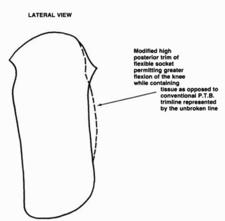 Figure 4. Lateral view of T.F.S. showing sugge | O&P Digital