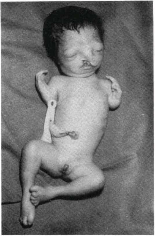 Roberts Syndrome Pictures