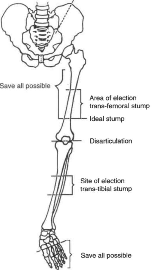 Fig. 1. Commonly Accepted Levels Of Amputation | O&P Digital Resource ...