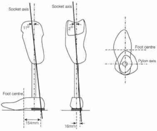 Fig. 3. Alignment Of PTB Prosthesis. | O&P Digital Resource Library