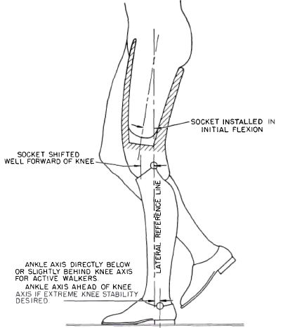 Fig. 4. Influence of alignment on control of knee | O&P Digital ...