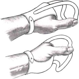 Fig. 39. Prosthesis for transmetacarpal amputa | O&P Digital Resource ...