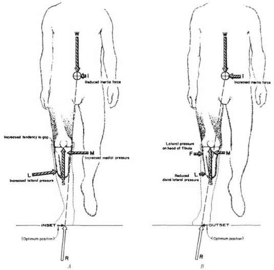 Fig. 4. Change in mediolateral force diagram | O&P Digital Resource Library