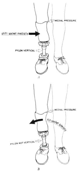 Fig. 34. Two faults in mediolateral alignment | O&P Digital Resource ...