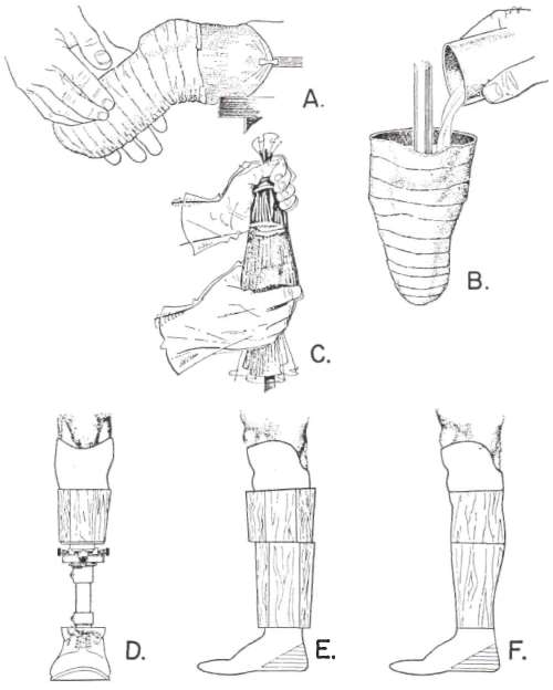 Fig. 1. Steps in the fabrication of a plastic | O&P Digital Resource ...