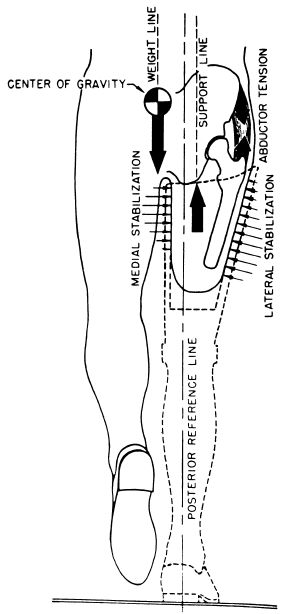 Fig 20B-3. Use of the hip abductors for latera | O&P Digital Resource ...