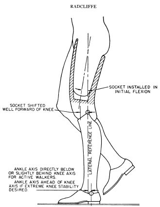 Fig 20B-8. Socket aligned in initial flexion t | O&P Digital Resource ...