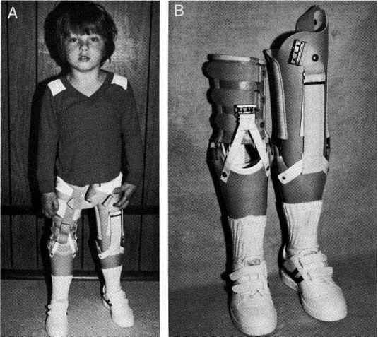 Fig 24A-9. A, 8-year-old boy with a right Syme | O&P Digital Resource ...