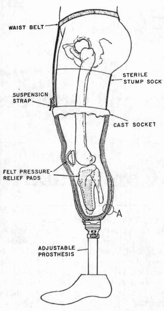 Schematic lateral view of method first recomme | O&P Digital Resource ...