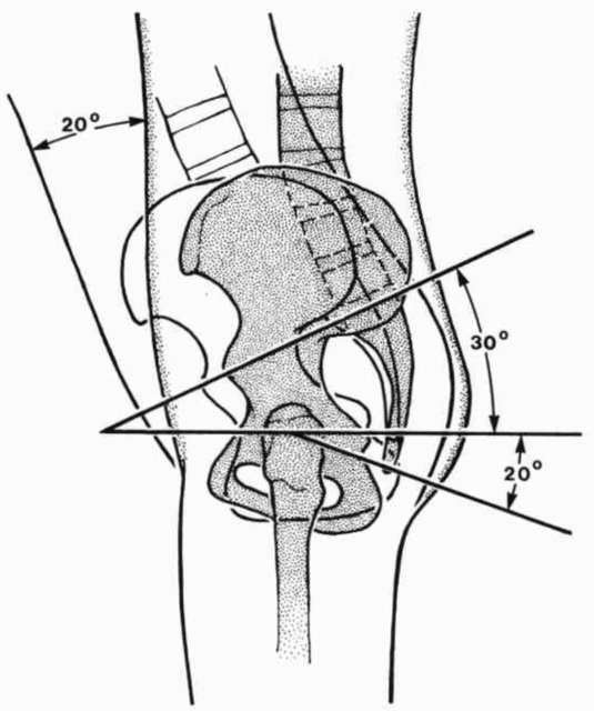 Figure 4. Schematic lateral view of normal lum | O&P Digital Resource ...