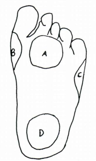 Figure 6. The typical reflexogenous areas (a) | O&P Digital Resource ...