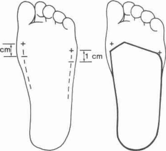 Fig. 5. Left, marking of first and fifth metatarsa | O&P Digital ...