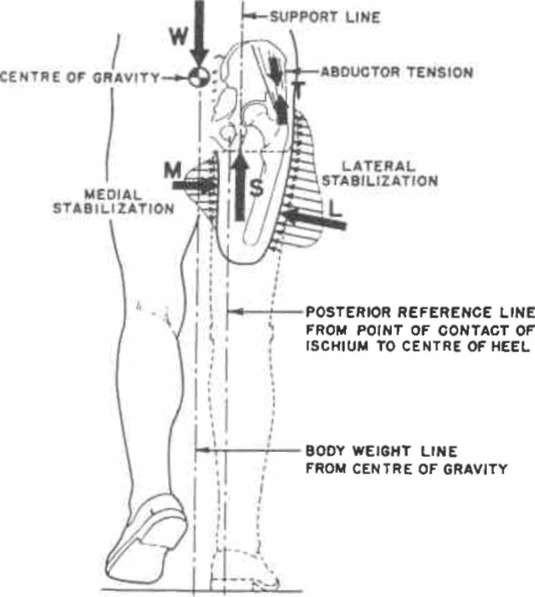 Fig. 2. Lateral stabilization of the pelvis (R | O&P Digital Resource ...